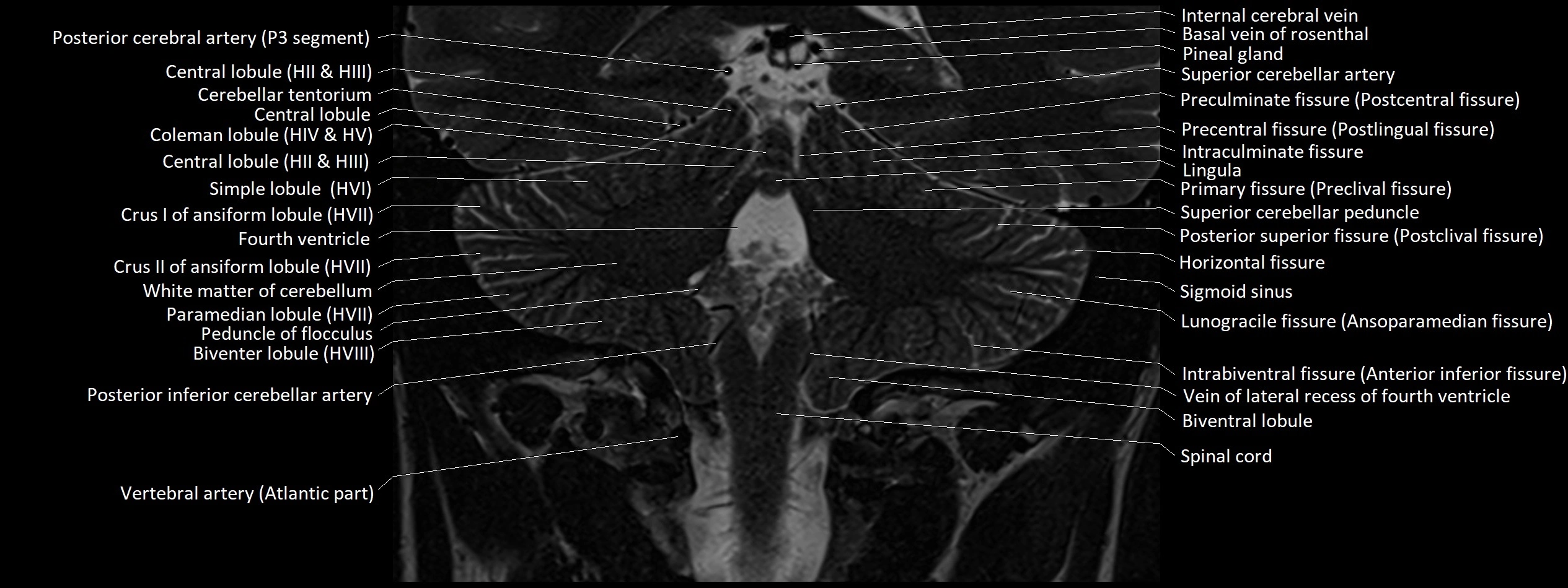 Anatomy of cerebellum coronal cross sectional 3T image 9.webp